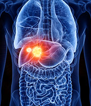 Liver Tumour/Cancer