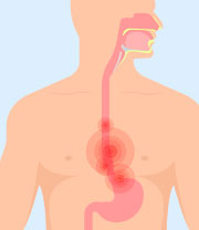 Oesophageal Stricture Following Corrosive Poisoning