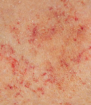 Petechiae (red or purple colored spots on the body)