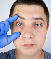 Skin and eyes that appear yellowish (jaundice)